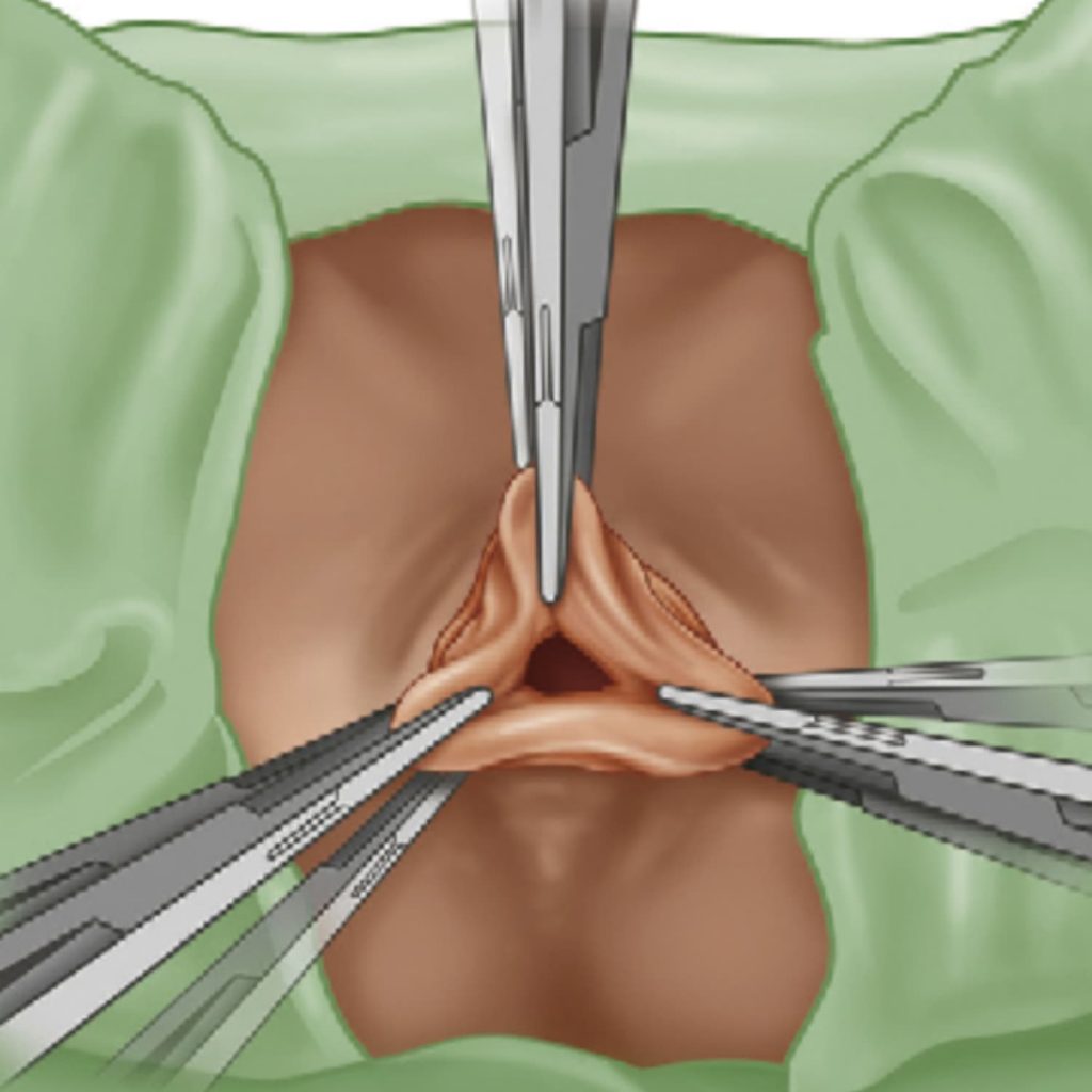 La fistule anale – Hémorroïdes Lyon